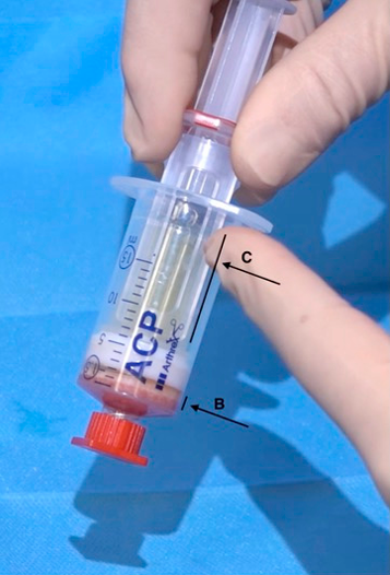 Platelet Rich Stroma (PRS) Injection