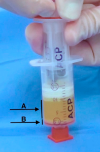 Lipoharvesting and the Fractionation of Adipose Tissue (FAT) Procedure